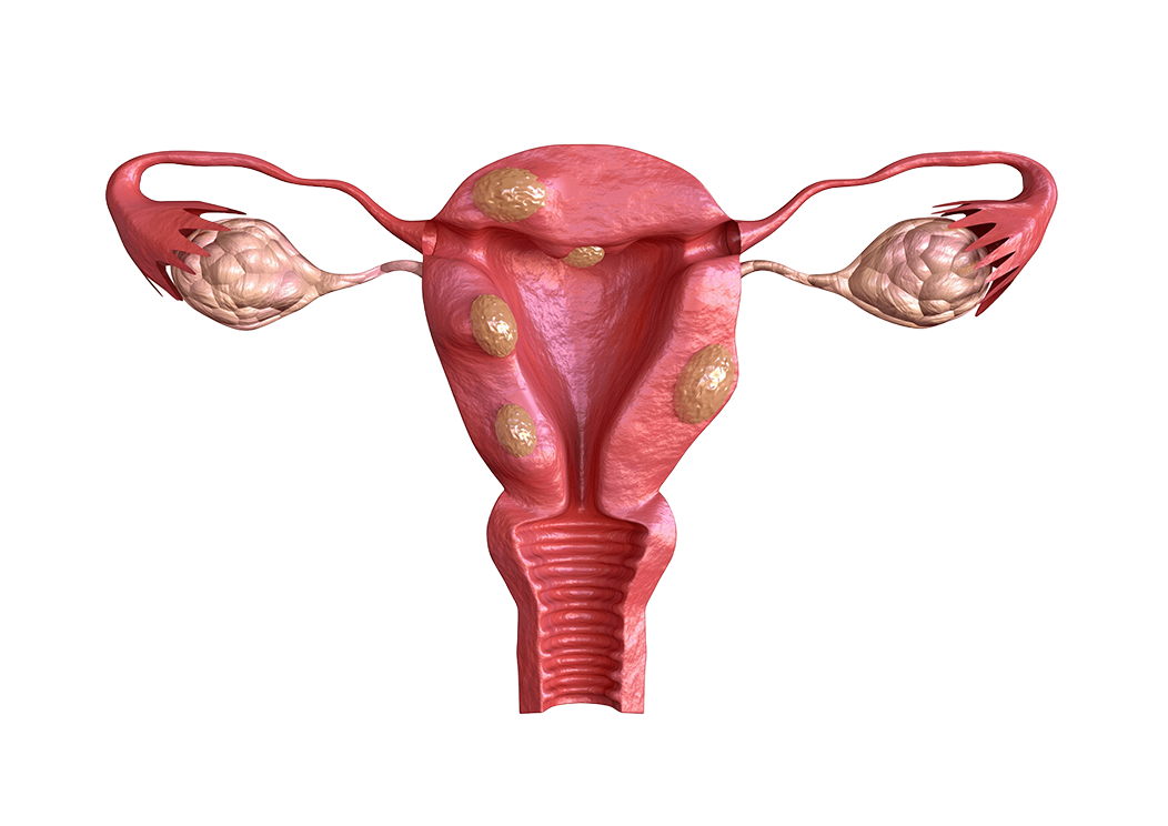 uterine fibroid.png